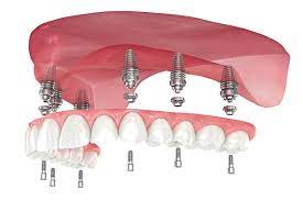 Common Questions About Implant Supported Dentures - Rowley Family Dental  Center Rowley Massachusetts